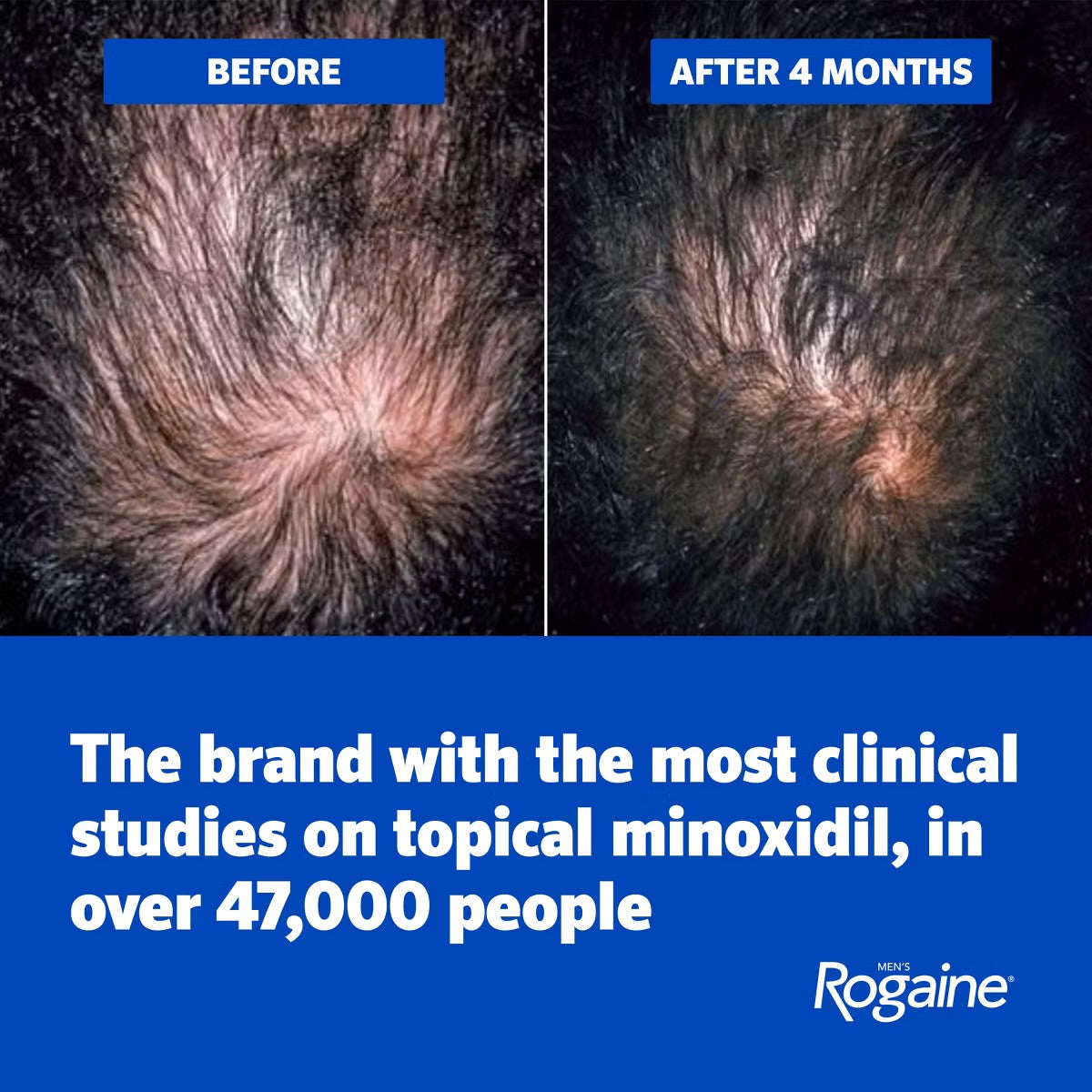 ROGAINE 5% MINOXIDILFOAM FOR HAIR REGROWTH